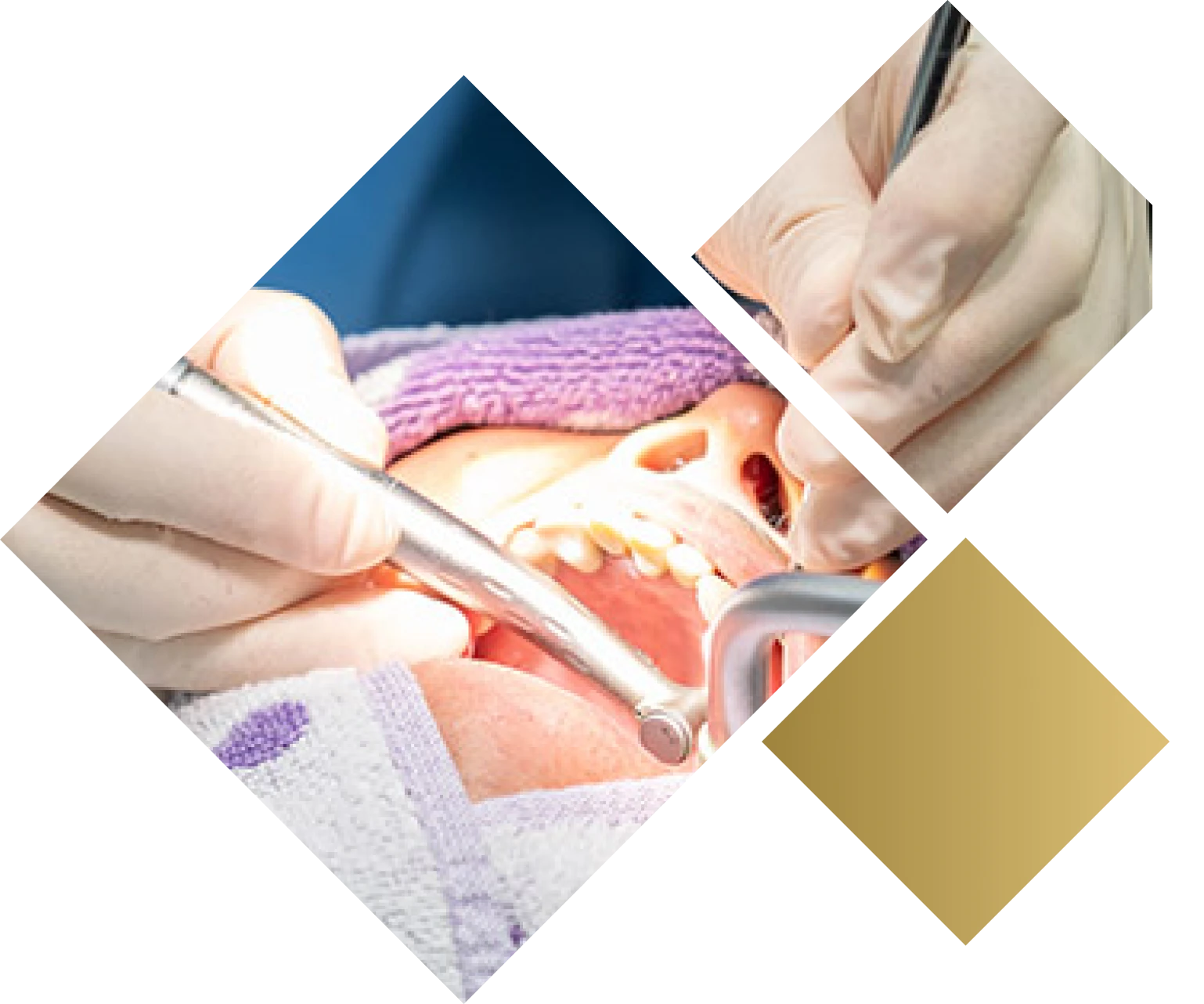 インプラントの手術方法